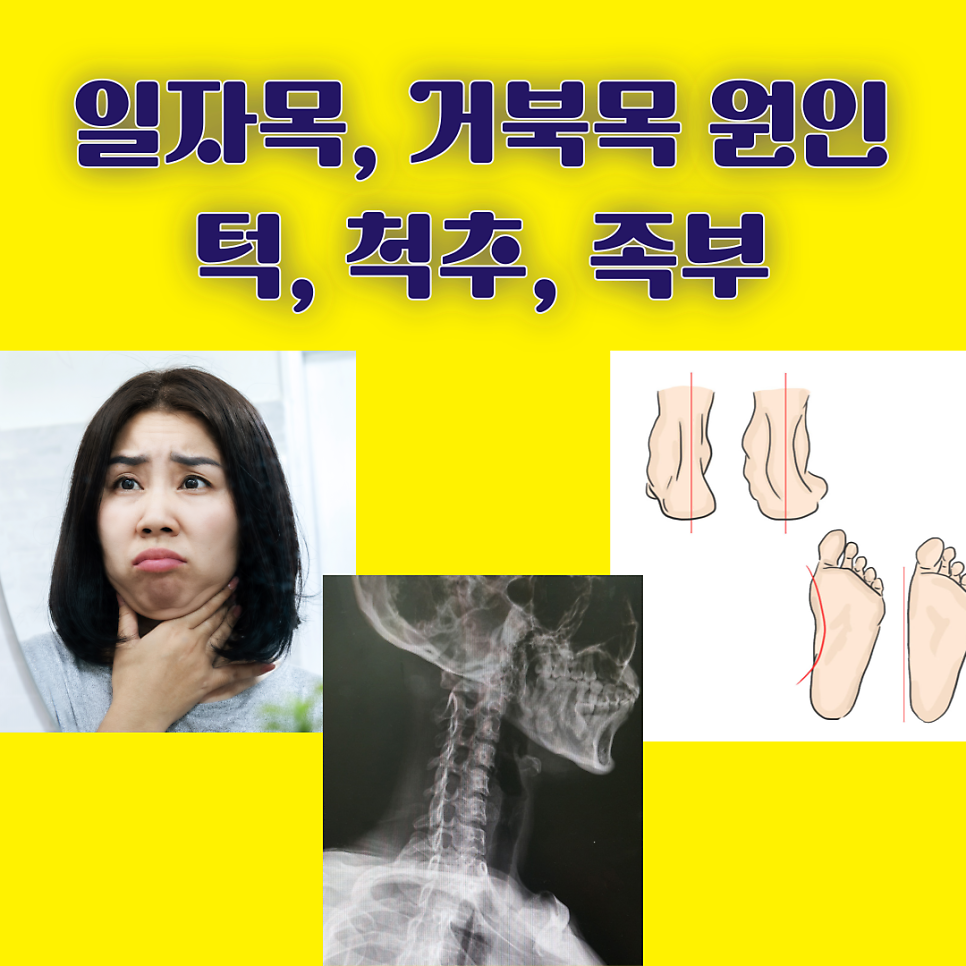 일자목, 거북목 교정기 사용 전에 원인부터 확인하세요.