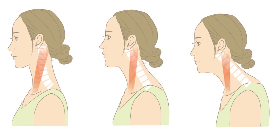 거북목, 일자목 관리하지 않으면 목디스크까지? 서울 관악구 핏한의원이 말하는 경추 교정의 중요성