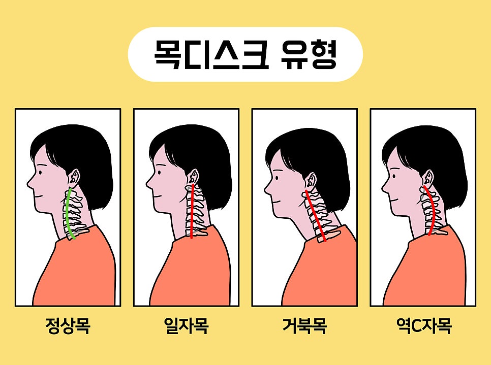 자세 하나가 목통증을 만든다! 봉천동한의원에서 일자목의 원인과 해결법을 알려드립니다.