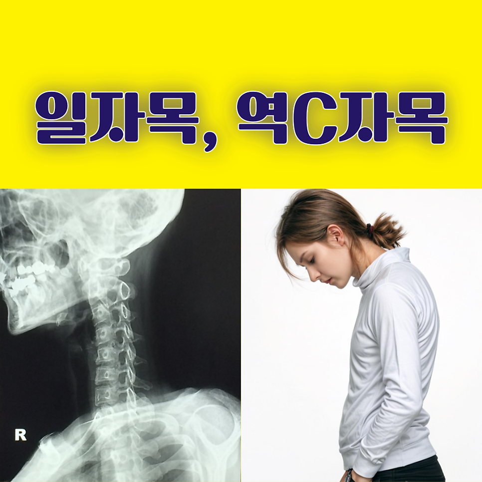 일자목에서 역 C자목 되면 어떻게 교정할까?